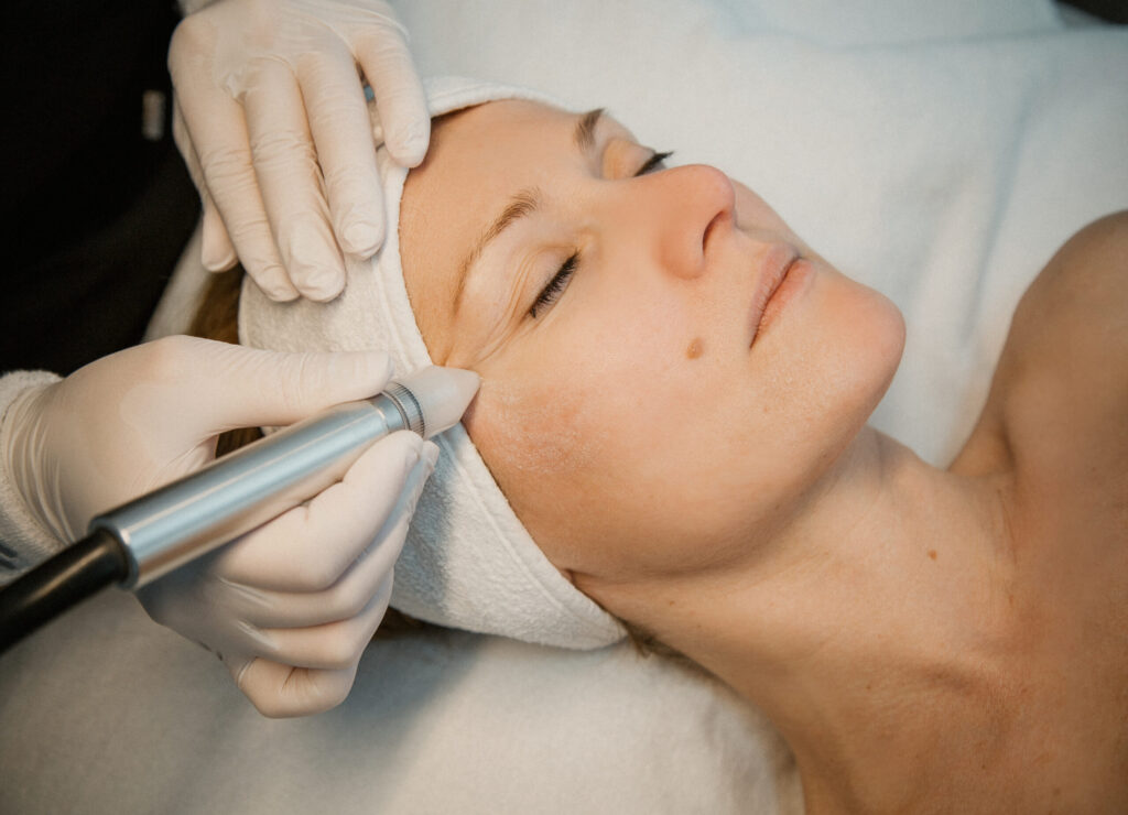 Microdermabrasion im Hautstudio Amy in Ravensburg während einer professionellen Gesichtsbehandlung