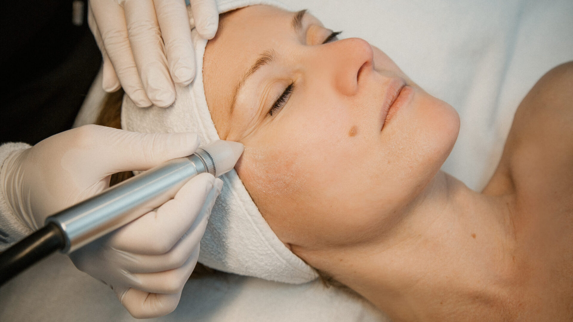 Microdermabrasion im Hautstudio Amy in Ravensburg während einer professionellen Gesichtsbehandlung