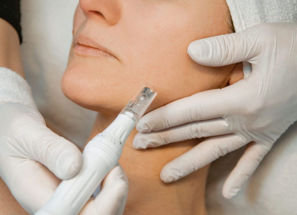 Microneedling-Behandlung im unteren Gesichtsbereich im Hautstudio Amy in Ravensburg