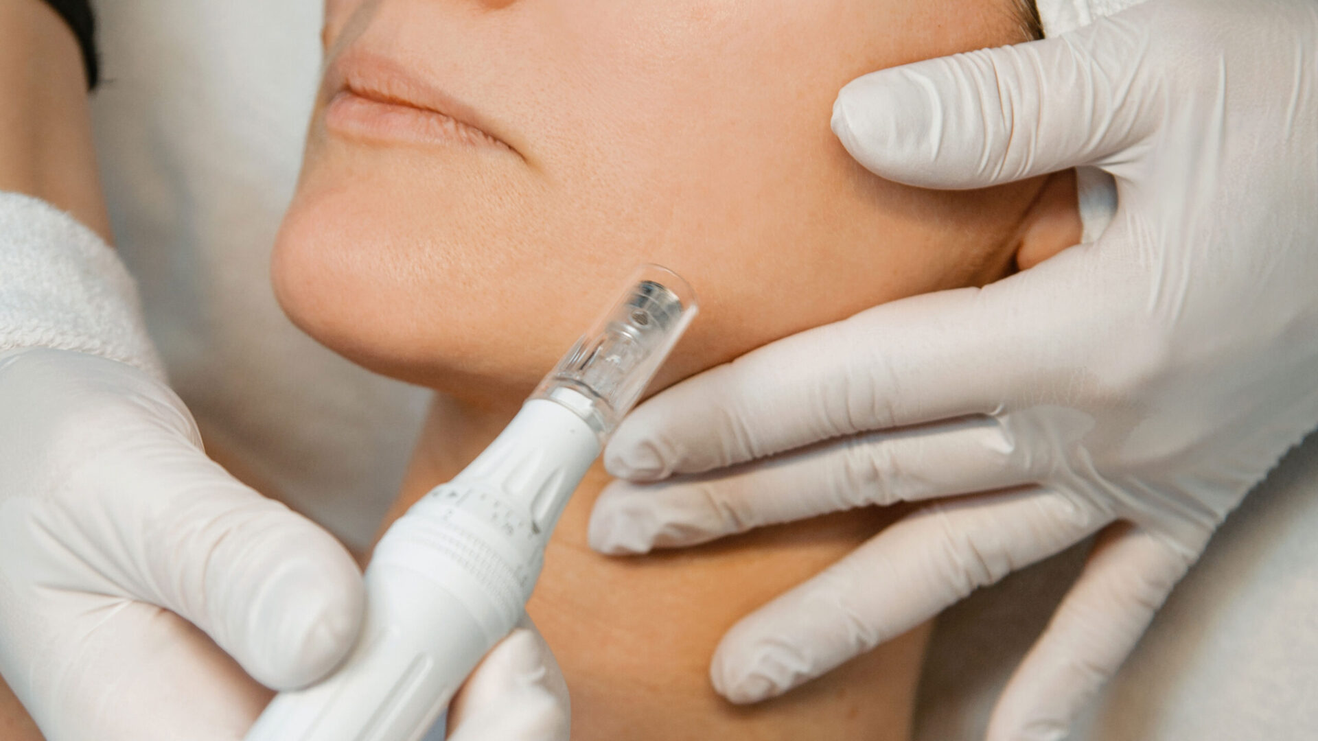 Microneedling-Behandlung im unteren Gesichtsbereich im Hautstudio Amy in Ravensburg